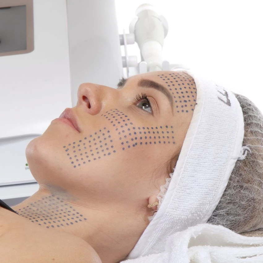 Ultrafocus HTM - marcação de protocolo facial completo