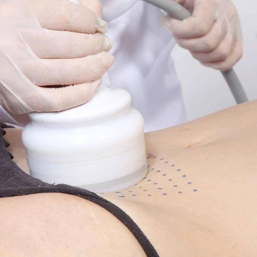 Ultrafocus HTM - aplicação corporal em abdômen