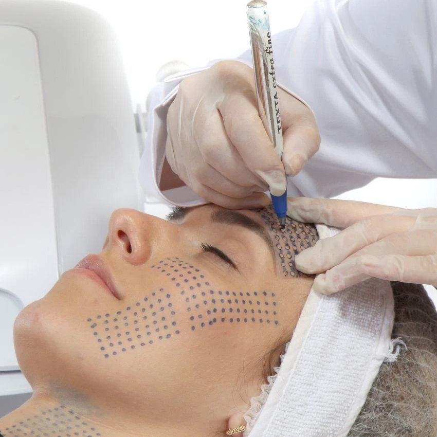 Ultrafocus HTM - marcação de protocolo facial
